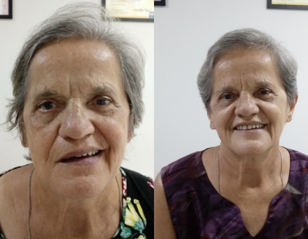 Antes e depois — recuperação de Paralisia de Bell com acupuntura